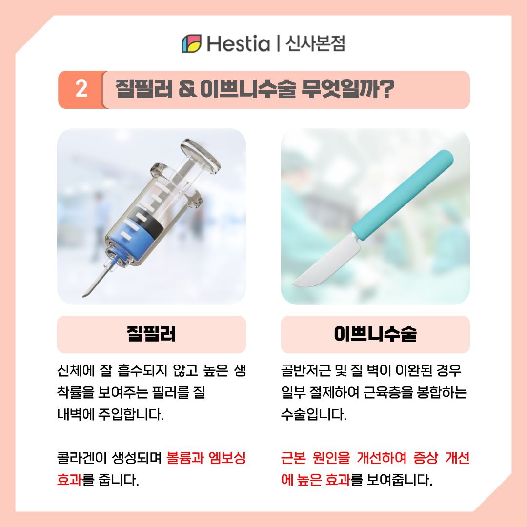 질필러와 이쁘니수술이 무엇인가요?