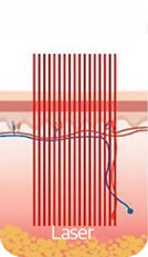 Fraxis Fractional Laser (두 가지 장점을 모두 갖춘 레이저)