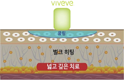 비비브 시술방식