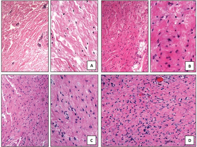 [ 비비브 시술 후 증가된 섬유아세포 (fibroblast) ]